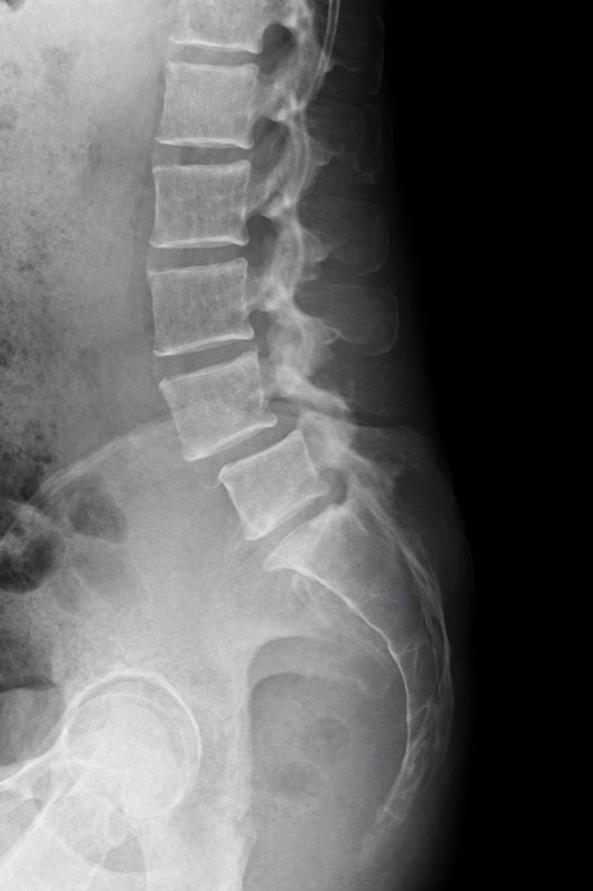 Espondilolistesis: Cuando una Vértebra se Desplaza